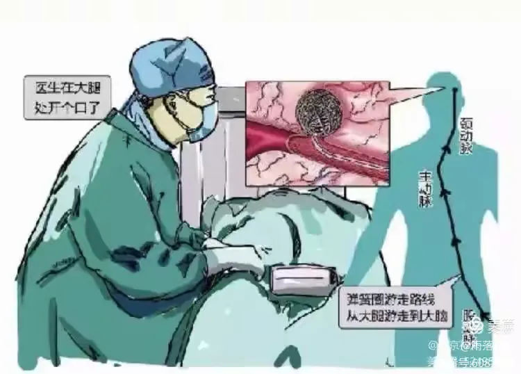 脑血管介入术后常见问题